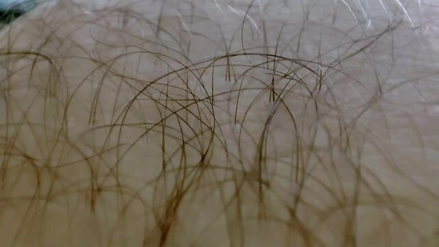 Macro of human hairy skin. Dermatology concept. Excessive hair growth
