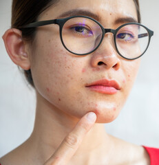 Headshot of Asian woman pointing to acne occur on her face. Inflamed acne consists of swelling,...
