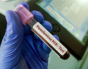 Fototapeta premium Blood sample for Parechovirus PCR test