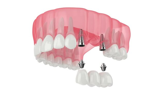 Upper jaw with implants supporting dental bridge 