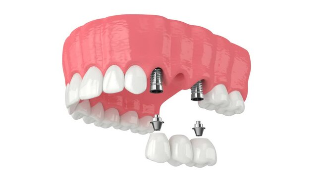 Upper jaw with implants supporting dental bridge 