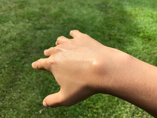 Ganglion cyst on right wrist, open hand. Health problem because overusing computer and smartphone.