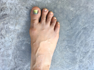 Discolouration of nails after chemotherapy. Side effects from breast cancer treatment.