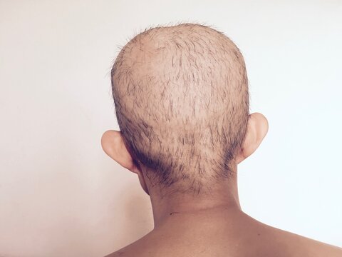 Woman's hair loss resulting from chemotherapy. Side effects from cancer.