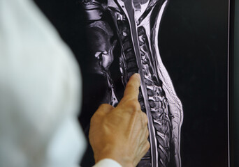 Doctor pointing at cervical spine MRI