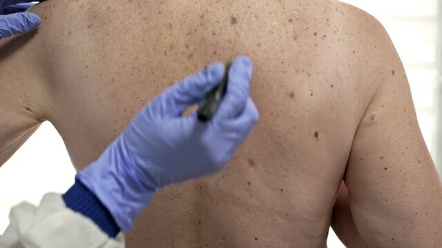 Dermatologist examines the patient's moles and marks the ones to be removed.