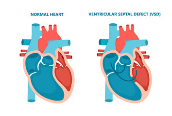 Ventricular septal defect VSD. Human heart muscle diseases cross-section. Cardiology concept.
