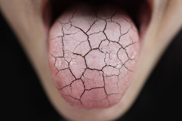 Woman Unhealthy Cracked Dry Tongue