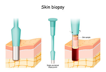 Skin Biopsy. Punch biopsy take skin sample.