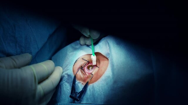 Laser vision correction. A patient and team of surgeons in the operating room during ophthalmic surgery. Eyelid speculum. Lasik treatment. Patient under sterile cover