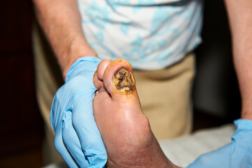 cutaneous ulcer on the first toe in an elderly diabetic person - obrazy, fototapety, plakaty