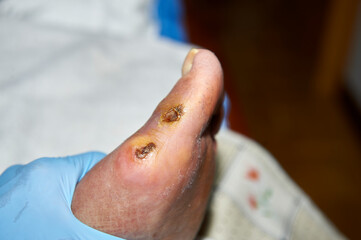 cutaneous ulcer on the first toe in an elderly diabetic person