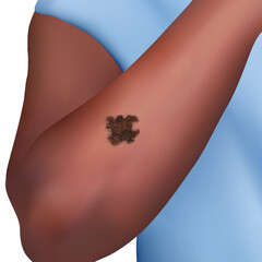 Illustration showing melanoma on the arm. A cancer arising from the skin's melanocytes, the cells that produce the pigment melanin that gives skin its colour. - obrazy, fototapety, plakaty