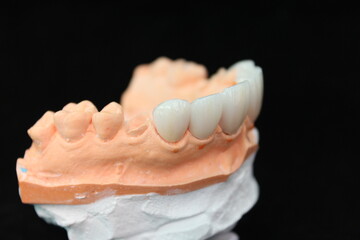 Dental crowns and veneers in the plaster model