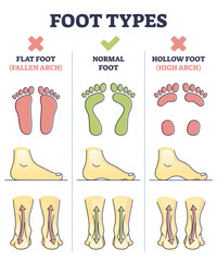 Foot types with flat, normal and hollow feet comparison in outline diagram. Educational medical explanation side view with orthopedic leg and medical deformation vector illustration. Footprint shapes.