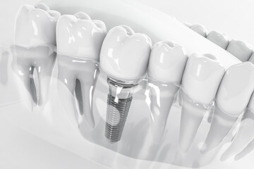 Detail of a false tooth implant fixed in the jaw