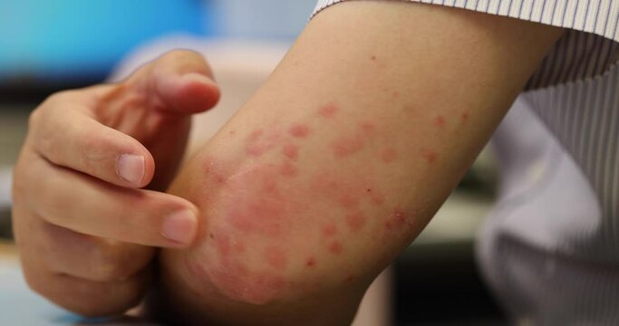 mosquito bits skin of man's elbow, creating a large area of bump, itching, swelling, soreness, and redness. hand cannot help scratching