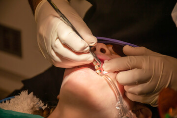 Bonding of dental braces. Orthodontic treatment. Dentist put on metal brackets using adhesive glue....
