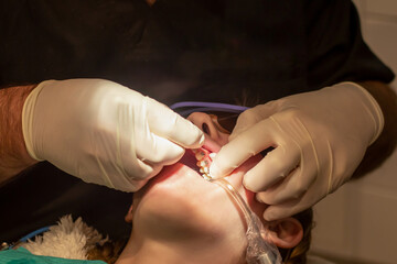 Bonding of dental braces and expander. Orthodontic treatment. Dentist put on archwire on metal...