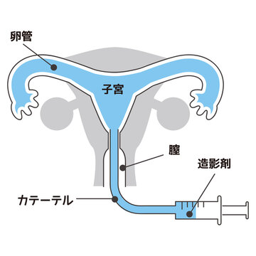 線画 子宮卵管造影検査
