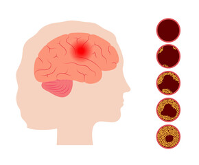 Brain stroke ishemic