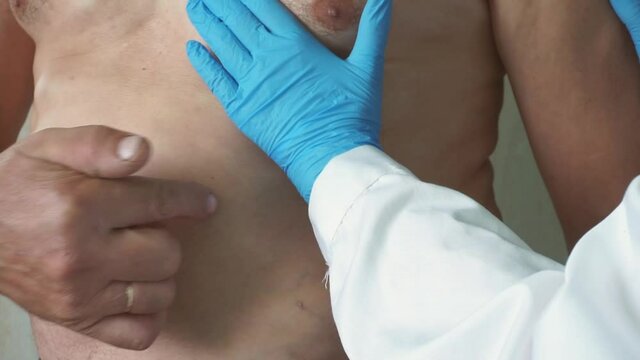 A doctor in blue rubber gloves and a white lab coat examines and palpates a man with lipomas - benign tumors on the body. multiple lipomas