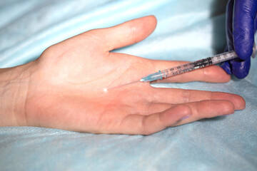 Anti-sweating injections into the patient's palm. Hyperhidrosis treatment, close-up