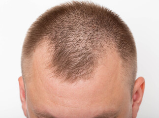 Bald patches on the head of a young man. The concept of the increased hormone dihydrotestosterone....