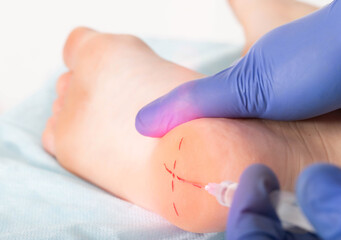 The doctor gives anesthesia to a patient in the leg who has plantar fascia pain. Pain relief for...
