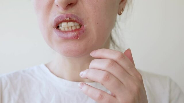Close up of girl lips affected by herpes. Treatment of herpes infection and virus. Part of young woman face with finger touching pain on lips with herpes affected. Beauty dermatology concept