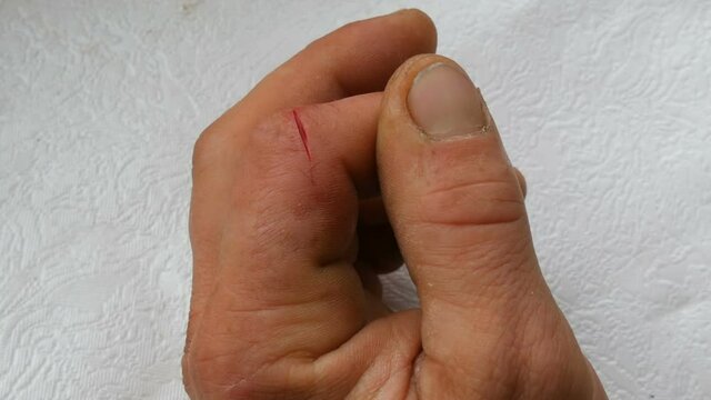 Deep cut on finger of men. Blood wound in phalanx