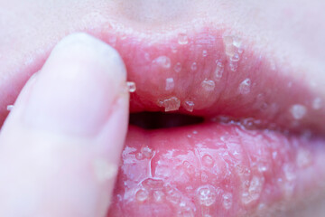 Lip scrub made with brown sugar and olive oil