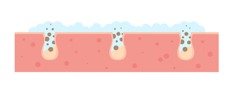 Cleaning blackheads process flat illustration. Clogged pores removal, skin cleaning foam, skincare. Can be used for topics like cosmetology, cosmetics. Shrinking and minimaizing face pores concept