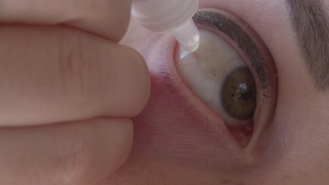 Woman Drips Medical Eye Drops Treating Red and Dry Eye a Macro Shot
