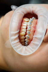 Installation of braces on teeth. Orthodontic dental treatment. Close-up of teeth with braces. High quality photo