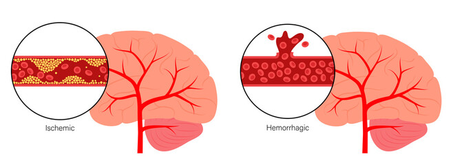 Brain stroke ishemic and hemorrhagic - 443723033