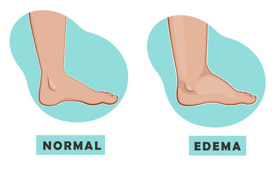 A swollen foot and ankle and a normal foot. Edema.  Vector illustration - obrazy, fototapety, plakaty