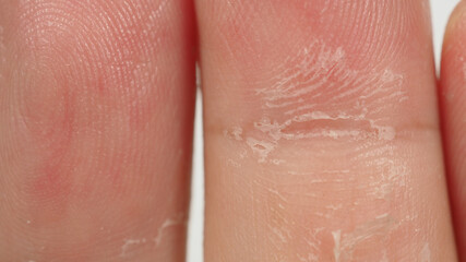 Fototapeta premium Skin peeling on hand and finger isolated on white background.Isolated