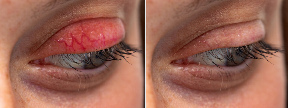 Human eye upper eyelid chalazion before and after side by side blepharitis comparison