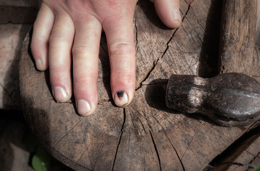 Hammer and human finger with dark bruised nail. Finger injury. Black hematoma on nails after...