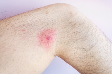 赤く腫れた男性の腕の写真。皮膚炎・皮膚病のイメージ。