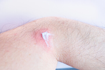 赤く腫れた男性の腕の写真。皮膚炎・皮膚病のイメージ。塗り薬を付ける。
