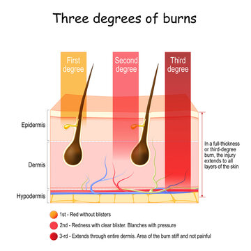skin burn. Three degrees of burns. type of injury to skin