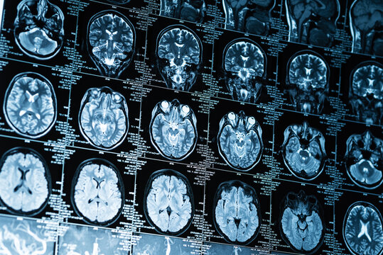 closeup series of MRI images of brain