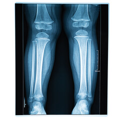 X-ray shot of legs, leg injury