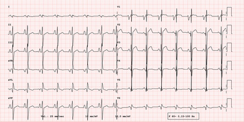 pathological example of ECG 12-lead rhythm,  patient with muscular dystrophy
