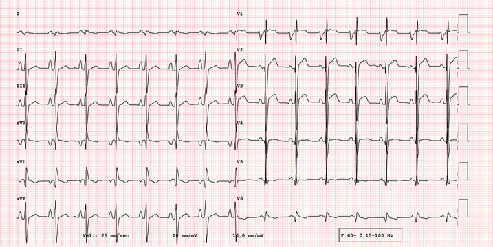 Pathological Example Of ECG 12-lead Rhythm,  Patient With Muscular Dystrophy