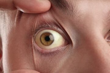 Man checking his health condition, closeup. Yellow eyes as symptom of problems with liver