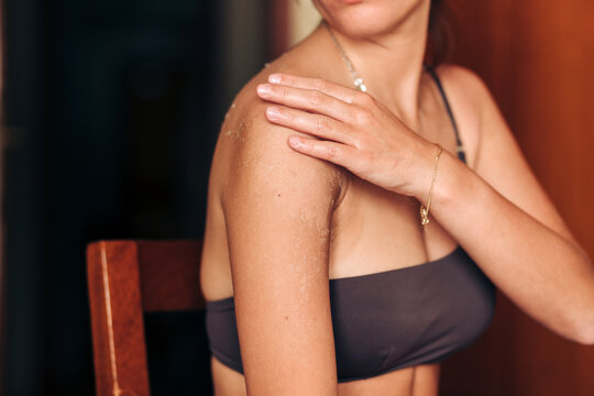 Damaged skin peeling off