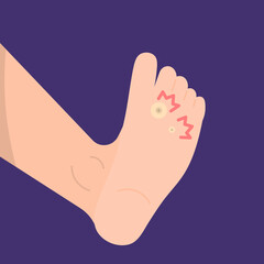 illustration of a foot affected by fish's eye disease or clavus. skin disease. pain or tenderness in the soles of the feet. flat cartoon style. vector design © Papcut design 